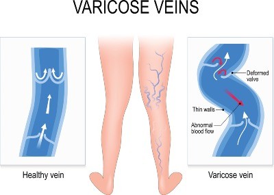 Diagram showing the causes of varicose veins outlining thin walls and deformed valves.