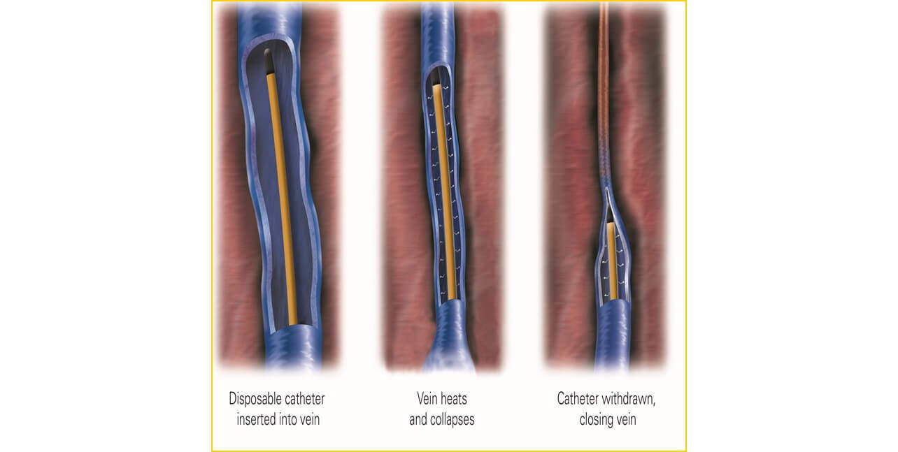 Diagram showing the process of closing a vein via thermal ablation.