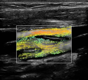Vascular ultrasound image showing blood flow through a blood vessel.